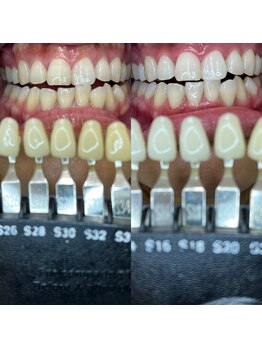 トウキョースワーズ 渋谷店(TOKYO SWRS)/#ホワイトニング #渋谷 #池袋