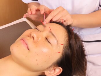 本八幡鍼灸院/話題の美容鍼
