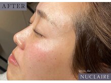 フーフラット(Huu flat)/ヌクレールフェイシャルワックス