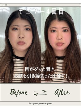 たいよう美容鍼灸院/Before After