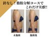 【痩身人気No2★最新×最短痩せ】針なし脂肪分解2部位＋爆燃焼マシン￥13980