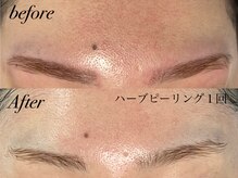 アンドナイン エス店(ANDNINE.)/ざらつきにもハーブピーリング