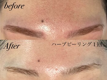 アンドナイン エス店(ANDNINE.)/ざらつきにもハーブピーリング