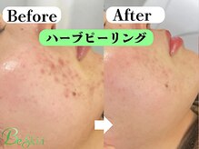 当店人気NO.1ハーブ×毛穴洗浄！コスパ最強/同時施術で効果UP◎