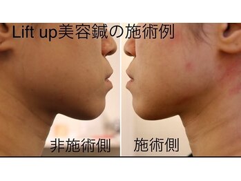 セットアップ鍼灸院(setup鍼灸院)/lift up美容鍼