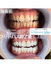 ホワイトニングサロン 福岡天神店/ホワイトニング