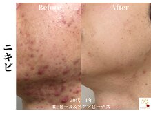 ローズフィールド(Rosefield)/RFピール/ニキビ/シミ/毛穴