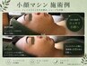 【平日12時～15時限定】最新小顔マシン＋毛穴洗浄＋高濃度人幹細胞 90分12800