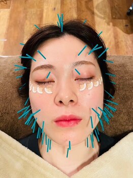 アウル なかもず店(OWL)の写真/40代以降女性【人気NO,1】プレミアム美容鍼(鍼80本＋リフトアップ電気鍼)
たるみ・しわ・食いしばりのケア