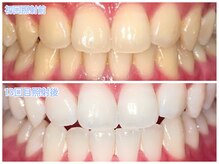 ホワイトニングラウンジ 横須賀店(ホワイトニングlounge)/【会員様before after】