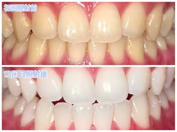 ホワイトニングラウンジ 横須賀店(ホワイトニングlounge)/【会員様before after】