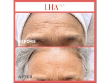 ランソ ビューティー 成田(RUNSO Beauty)/ララピール効果 シワ