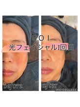 ソイ(soi)/一回でリフトアップ期待！