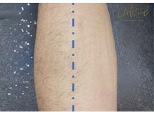 ラエッセ(LAESSE)/<メンズ>ひざ下脱毛