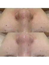 リンダ(Rinda)/クリスティーナ×毛穴洗浄