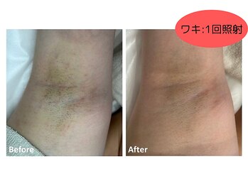 【脱毛・よもぎ蒸しサロン】Quokka/ワキ脱毛