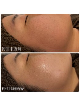 ブリエ(Briller)/毛穴・シミケア