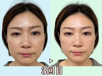 ナチュラルビューティーフェイス 横浜(NBF)/印象を変える小顔矯正