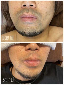サロン ルアナ(salon luana)の写真/【メンズ人気NO.1ヒゲ脱毛】初回は3150円◎デザインで残したい部分は残せます！