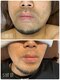 サロン ルアナ(salon luana)の写真/【メンズ人気NO.1ヒゲ脱毛】初回は3150円◎デザインで残したい部分は残せます！