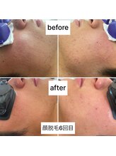 ラウラウ(laulau)/顔脱毛