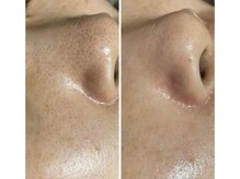 ミュウ(Myu)/フェイシャル