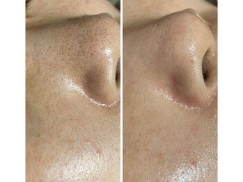 ミュウ(Myu)/フェイシャル