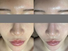 ミラン(MiLaN)/毛穴洗浄/ハイドラヴィーナス