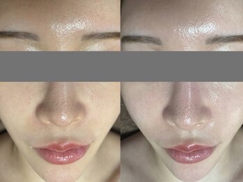 ミラン(MiLaN)/毛穴洗浄/ハイドラヴィーナス