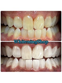 ホワイトニングショップ 吉祥寺店/BEFORE ＆ AFTER