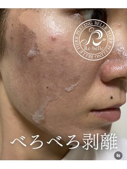 リラ 都城店(Lilas)/ハーブピーリング　3日目剥離