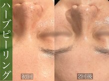 モア 星ヶ丘店(MORE)/ハーブピーリング