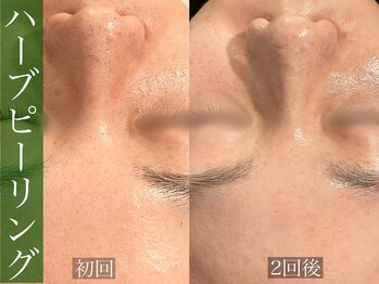 モア 星ヶ丘店(MORE)/ハーブピーリング