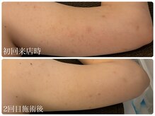 ブリエ(Briller)/二の腕の毛孔性苔癬にも◎