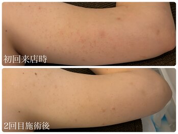 ブリエ(Briller)/二の腕の毛孔性苔癬にも◎