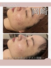 リラベル(Lira Belle)/ニキビケア、お任せください！