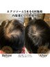 【頭髪/頭皮ケア】SCSエクソソーム5本×プラズマ照射　¥40700→¥37500