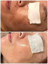 フランベル(Franc bell)/極艶玉肌生成＊光フォト美顔　