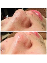 プリマ(Prima)/毛穴汚れ撃退