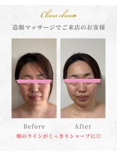 シュシュ(Chouchou)/小顔造顔マッサージ