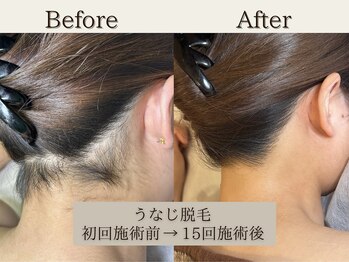 インベスト(INVEST)/うなじ脱毛