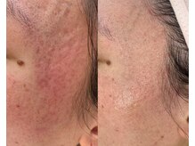 シール(Syl)/プロセルセラピーズ症例