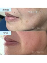 リシェル(Richelle)/【WHITELAB☆はがれるシミケア】
