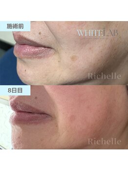リシェル(Richelle)/【WHITELAB☆はがれるシミケア】