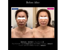 ベレピ(belepi)