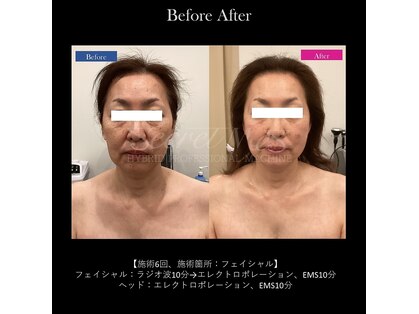 ベレピ(belepi)の写真