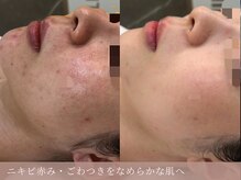 サロン ド ボーテ シャルル(Chaleureux)の雰囲気（ニキビ・赤み・ごわつき：LDM水玉×栄養補給オプション）
