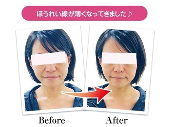 整骨院 壱/小顔矯正の変化
