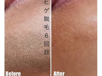 CDF 赤坂/メンズヒゲ脱毛6回目初回￥1000