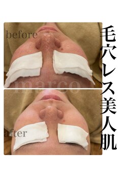 マルコ(marco)/毛穴